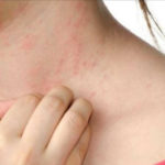 POSTAJE PANDEMIJA Alergije na hranu imaju ogromne razmere